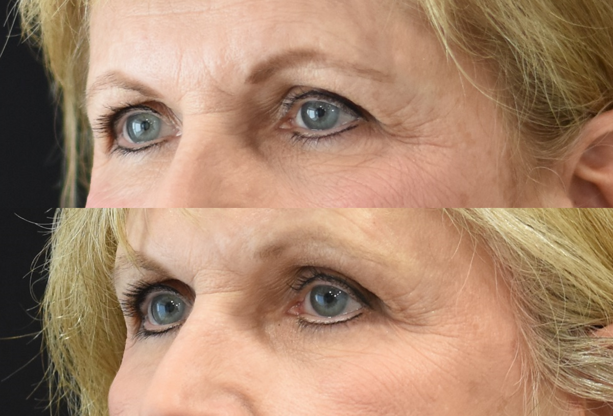 Facelift, Neck Lift, Brow Lift, Upper Eyelid (Blepharoplasty) Surgery, Lower Eyelid Skin Pinch Procedure Before & After in Cincinnati, Ohio