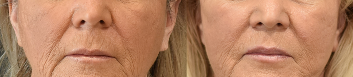 Lip lift in Cincinnati, Ohio