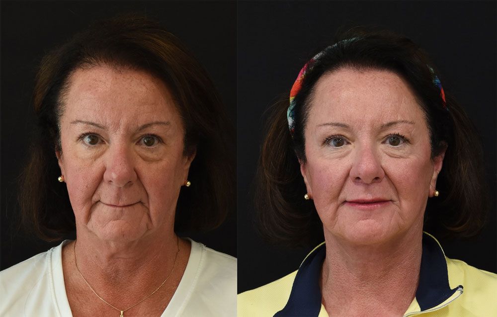 Extended Deep Plane Facelift in Cincinnati