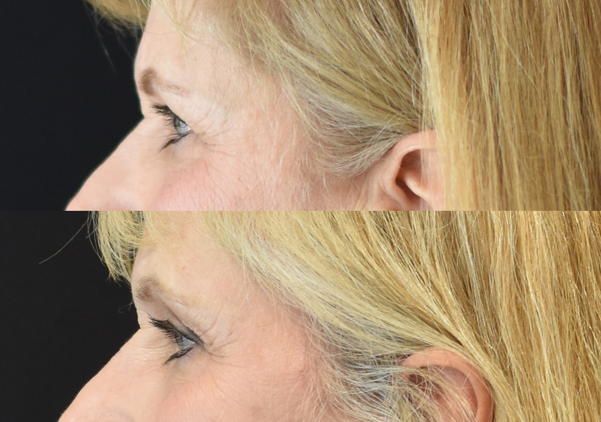 Facelift, Neck Lift, Brow Lift, Upper Eyelid (Blepharoplasty) Surgery, Lower Eyelid Skin Pinch Procedure Before & After in Cincinnati, Ohio