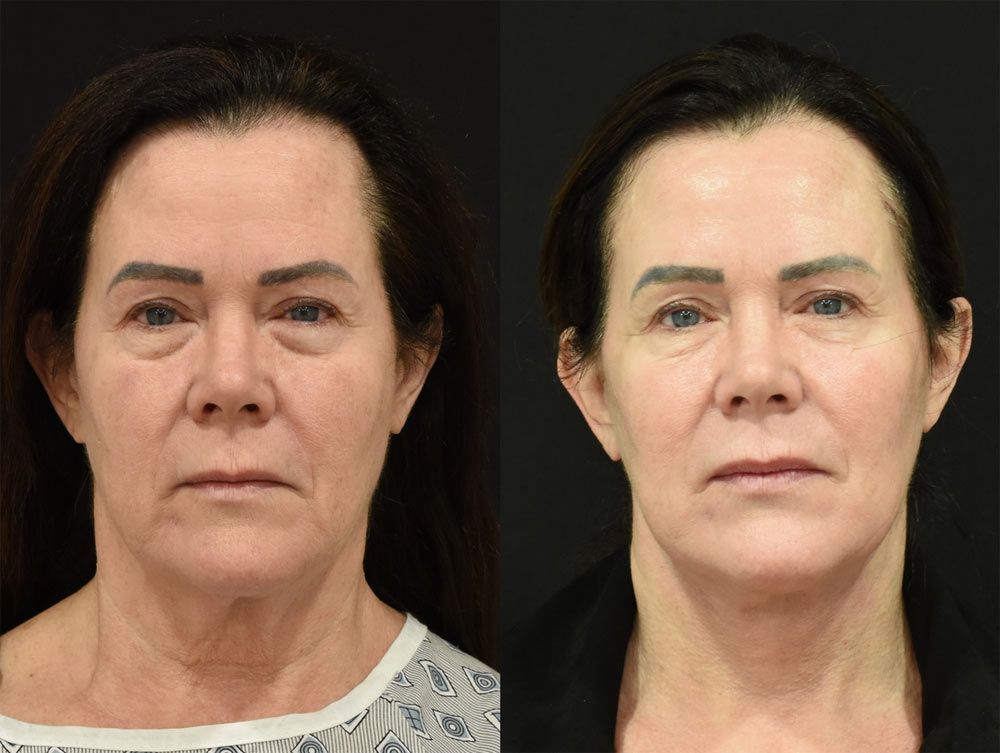 Cincinnati Deep Plane Facelift Before and After Front