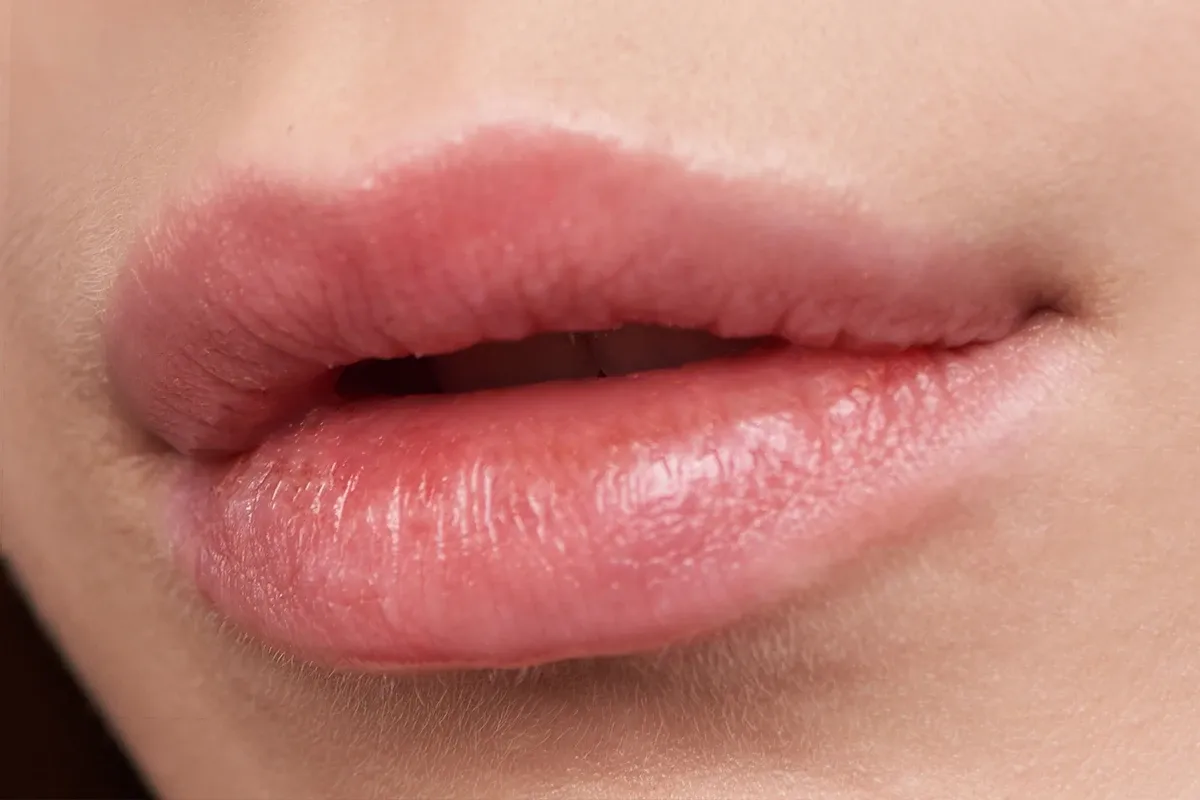 Lip Lift Under Local Anesthesia3