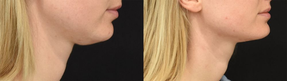 Neck Lift in Cincinnati
