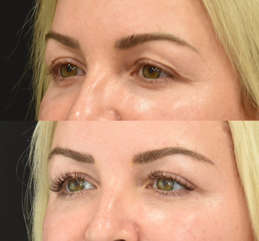 Brow Lift, Upper Eyelid (Blepharoplasty) Surgery, Lower Eyelid Skin Pinch Procedure Before & After in Cincinnati, Ohio