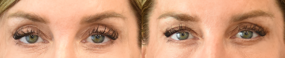 Lower Eyelid Skin Pinch Before-and-After in Cincinnati, Ohio